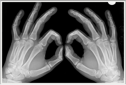 X-rayed Hands